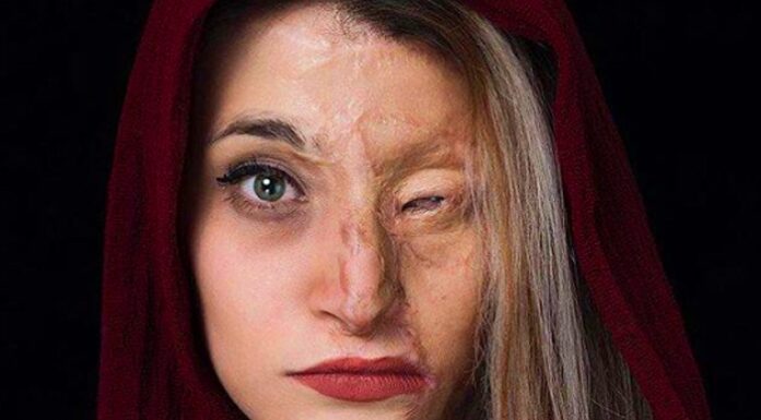 بررسی بزه اسیدپاشی علیه زنان ; بیش از نصف قربانیان اسیدپاشی را زنان تشکیل می دهند